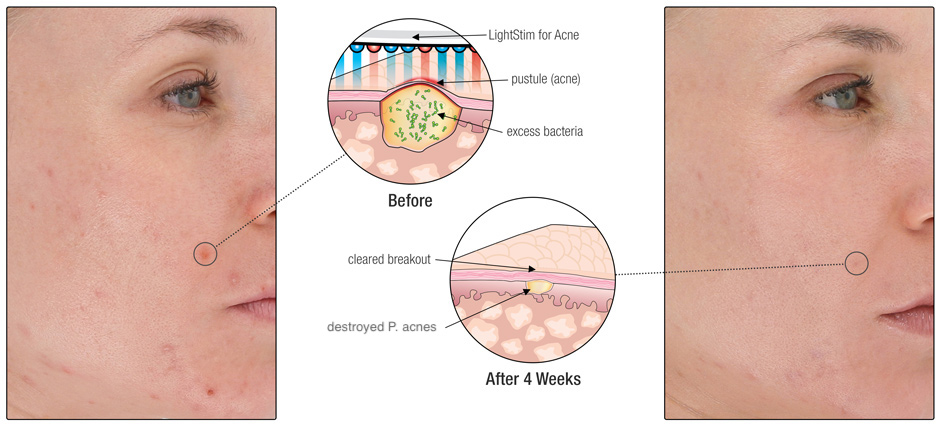 Acne South Tampa LED Light Therapy